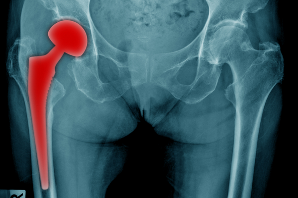 Best Hip Replacement Surgeon In Delhi