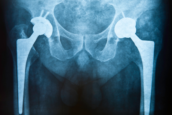 Best Hip Replacement Gurugram