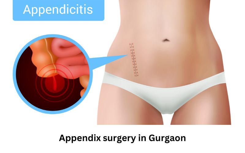 Appendix surgery in gurgaon