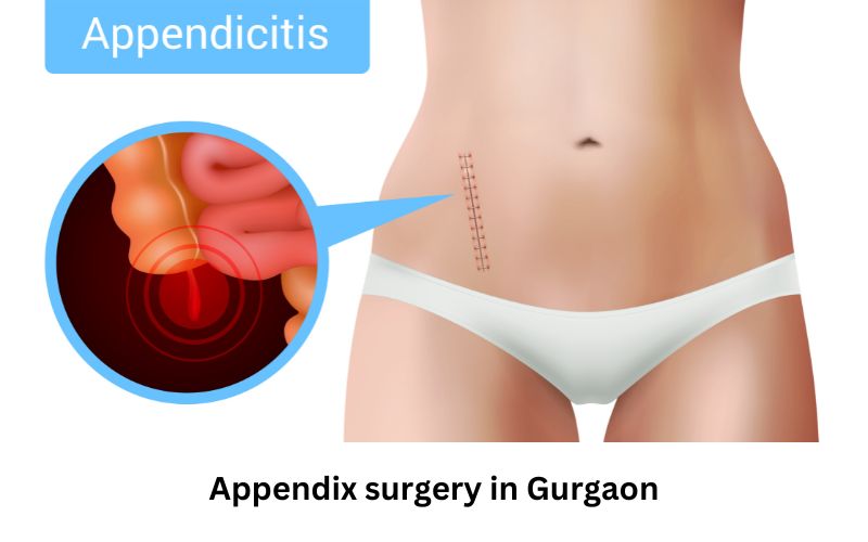 Best Appendix Treatment Hospital in Gurugram with expert surgeons