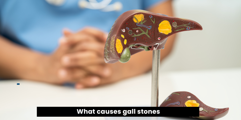 Gallstone treatment in Gurgaon