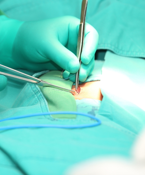 Laparoscopic hernia surgery in Gurgaon