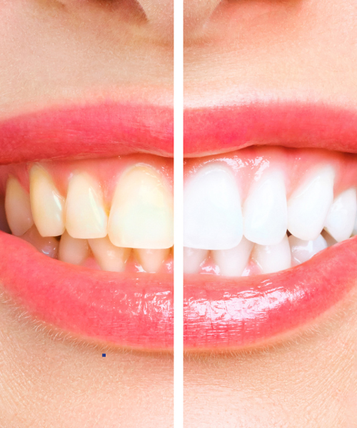 Professional teeth whitening treatment at Kalyani Hospital Gurgaon for a brighter smile