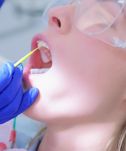 Fluoride Treatment in Gurgaon