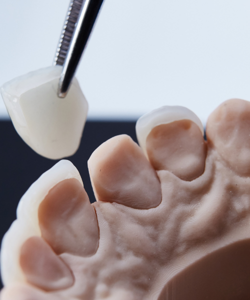Dental Crowns