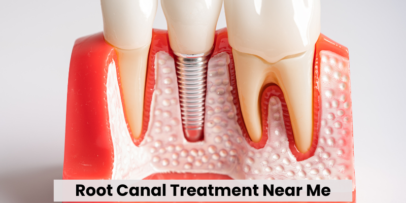 Root Canal Treatment Near Me
