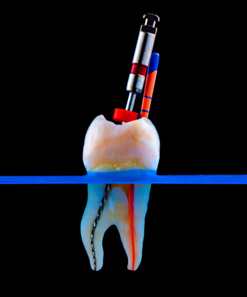 Root Canal Treatment