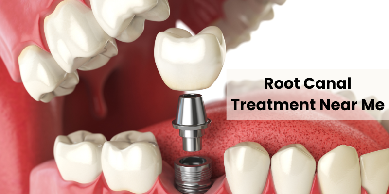 Root Canal Treatment Near Me