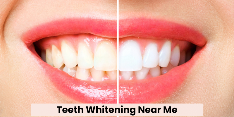 Teeth Whitening Near Me