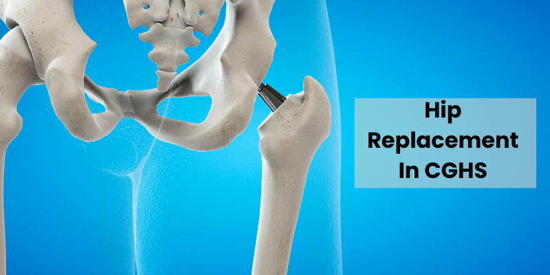 Hip Replacement in CGHS