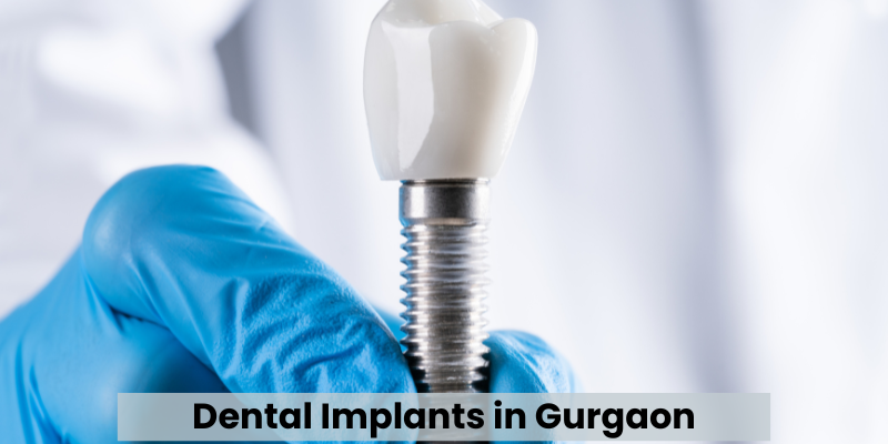 Dental Implants in Gurgaon