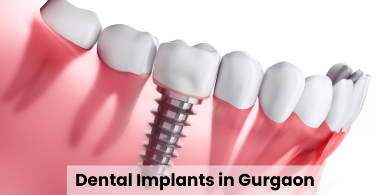 Dental Implants in Gurgaon