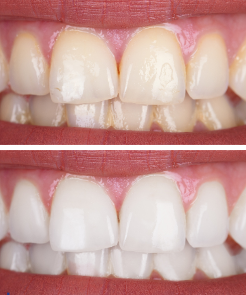 Deep Cleaning Teeth in Gurgaon