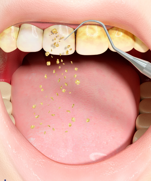 Deep Cleaning Teeth in Gurgaon