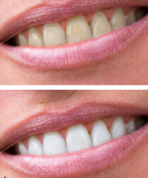 Teeth Whitening Treatment in Gurgaon