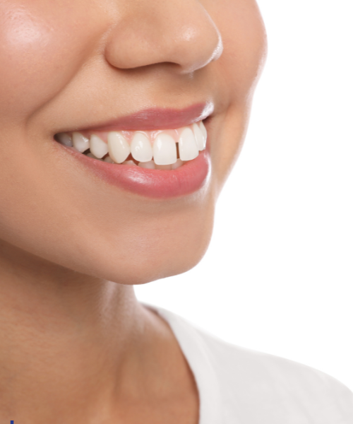 Teeth Gap Filling in Gurgaon