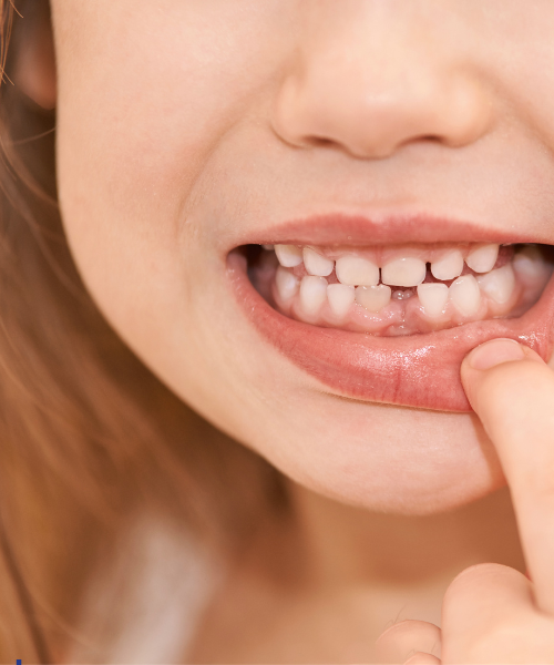Teeth Gap Filling in Gurgaon