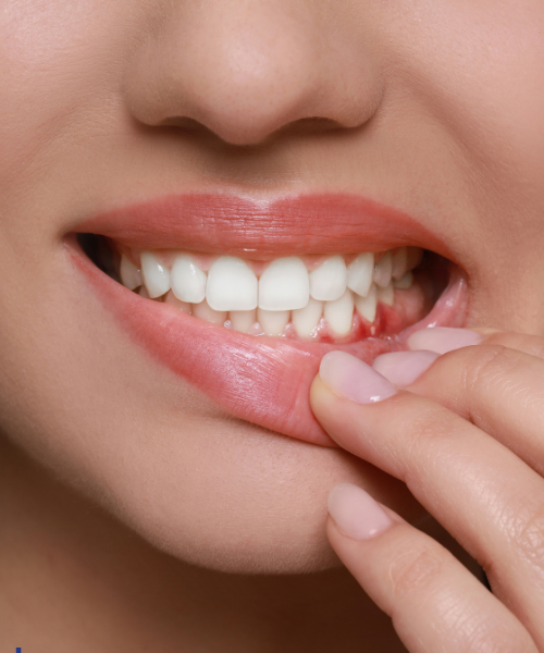 Bleeding Gums Treatment