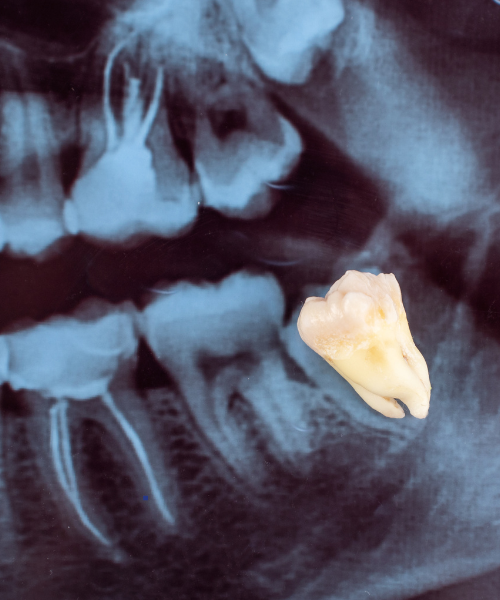 Wisdom tooth removal consultation at Kalyani Hospital Gurgaon