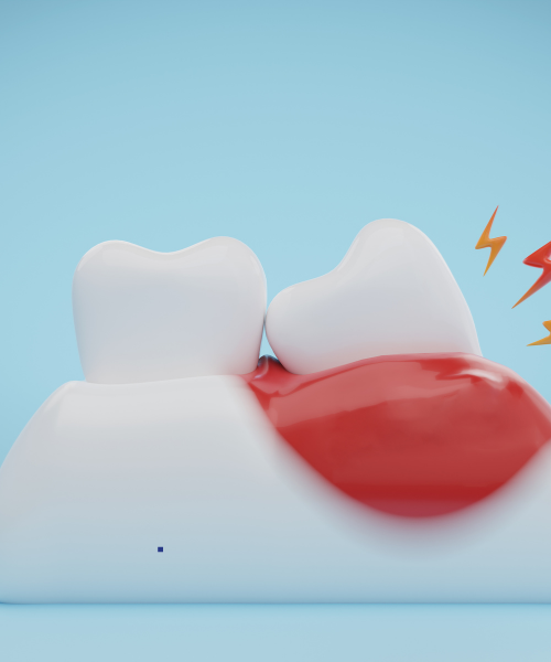 Patient with bleeding gums receiving deep cleaning treatment in Gurgaon