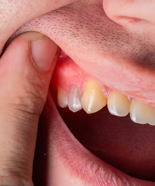 Happy patient after gum disease treatment at Kalyani Hospital Gurgaon