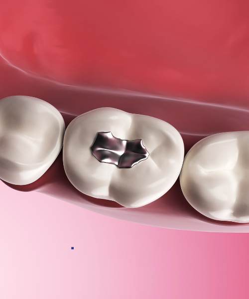 Dental Filling