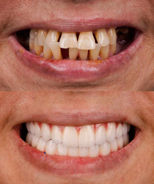 Full Mouth Rehabilitation