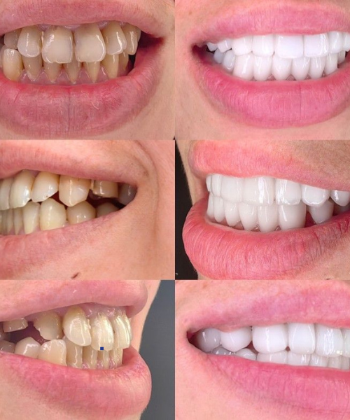 Full Mouth Rehabilitation