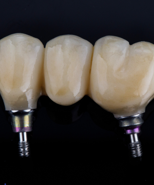 Dentures and Bridges
