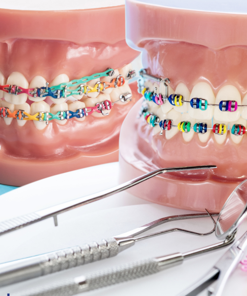 Braces Treatment