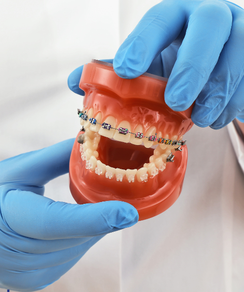 Braces Treatment