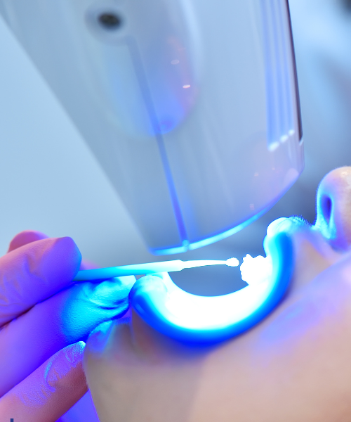 Laser Gum Treatment in Gurgaon