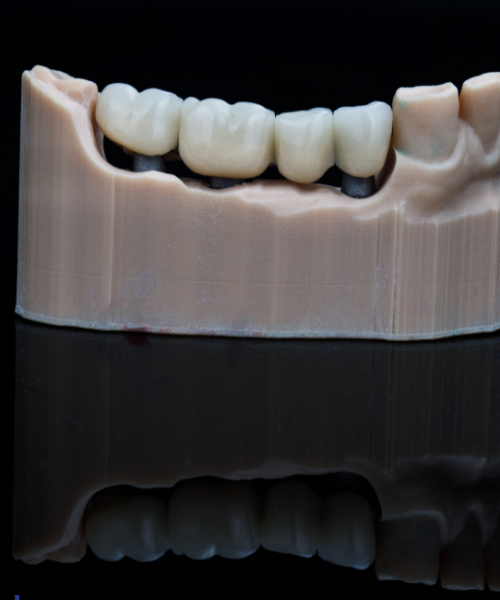 Dental Bridge in Gurgaon