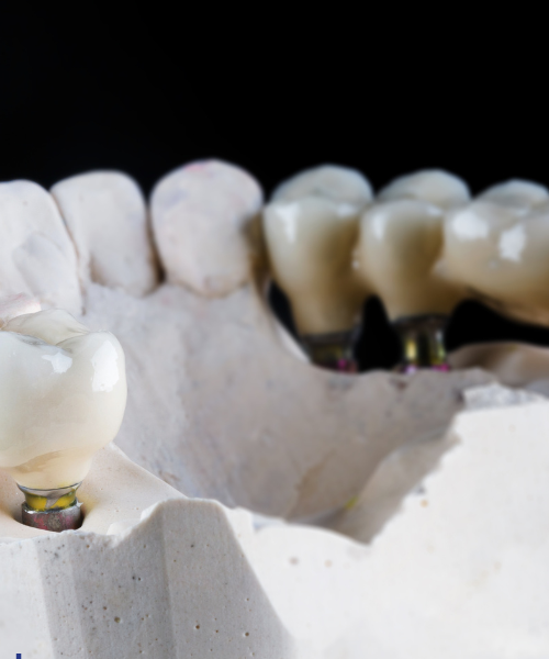 Dental Bridge in Gurgaon