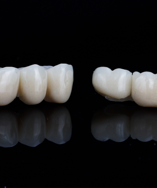 Dental Bridge in Gurgaon