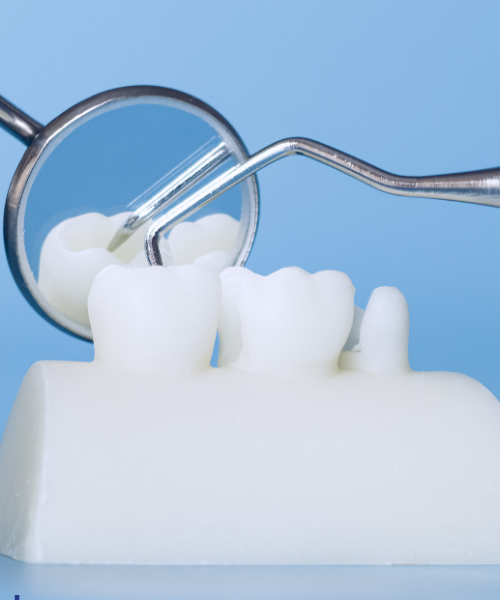 Dental Bridge in Gurgaon