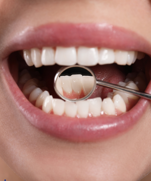 Pulpotomy in Gurgaon